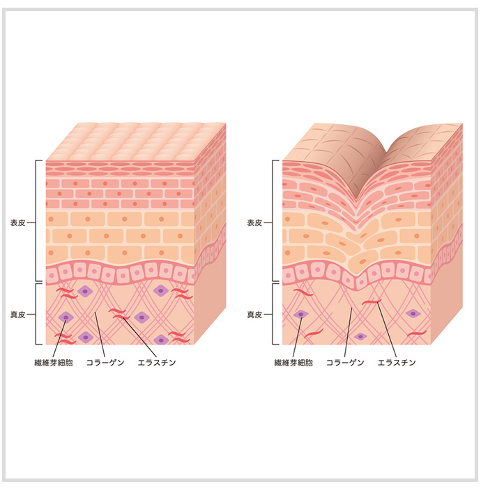 健康な皮膚とシワができた皮膚の構造図